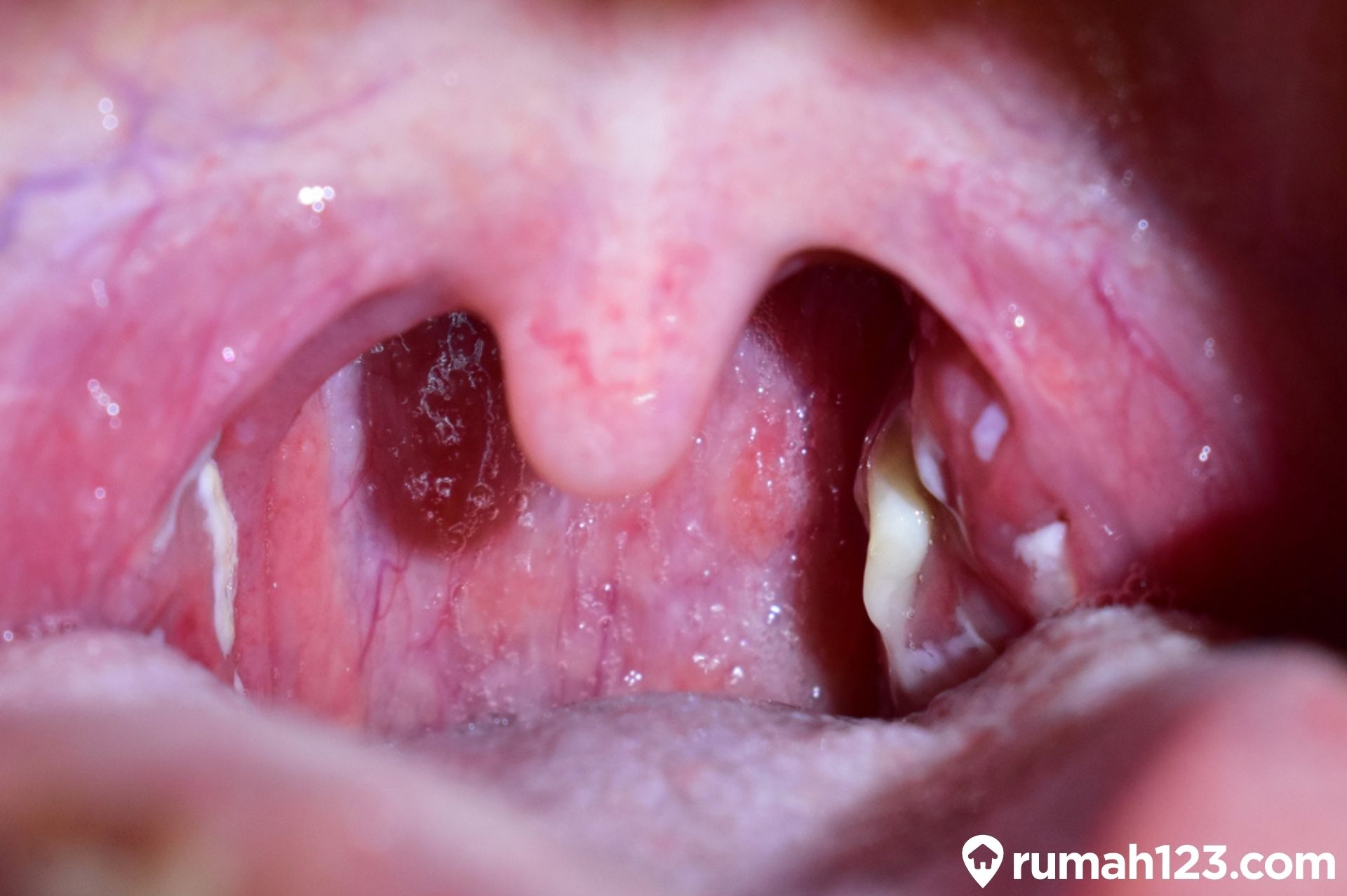 Obat untuk Radang Tenggorokan pada Anak