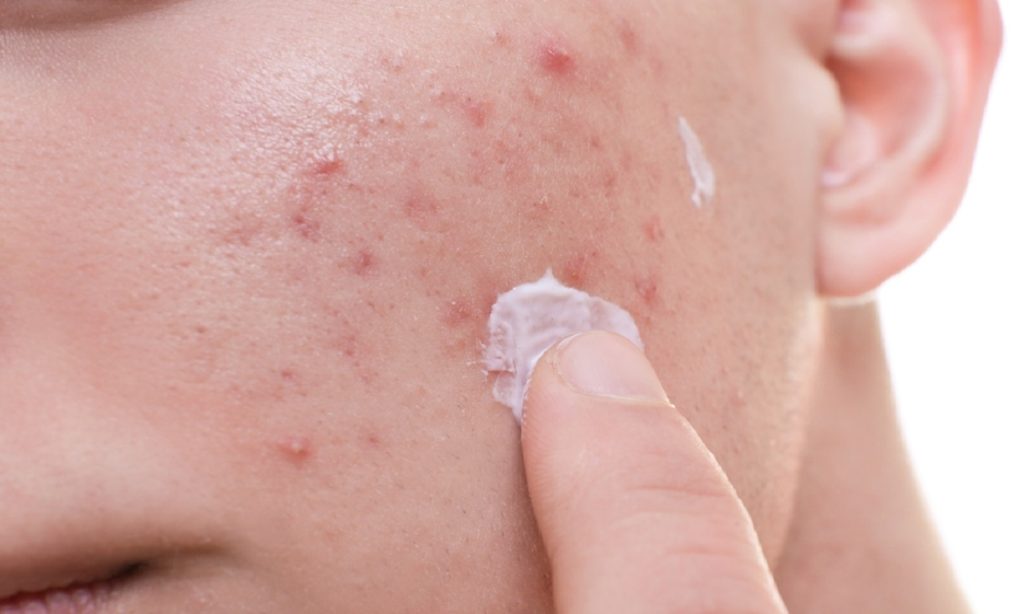 7 Rekomendasi Krim Penghilang Bekas Jerawat, Kulit Kembali Halus!